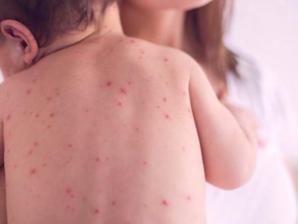 ХӨСҮТ: Улаанбурхан өвчний лабораториор батлагдсан 5075, эмнэлэгт 647 хэвтэн эмчлүүлж байна