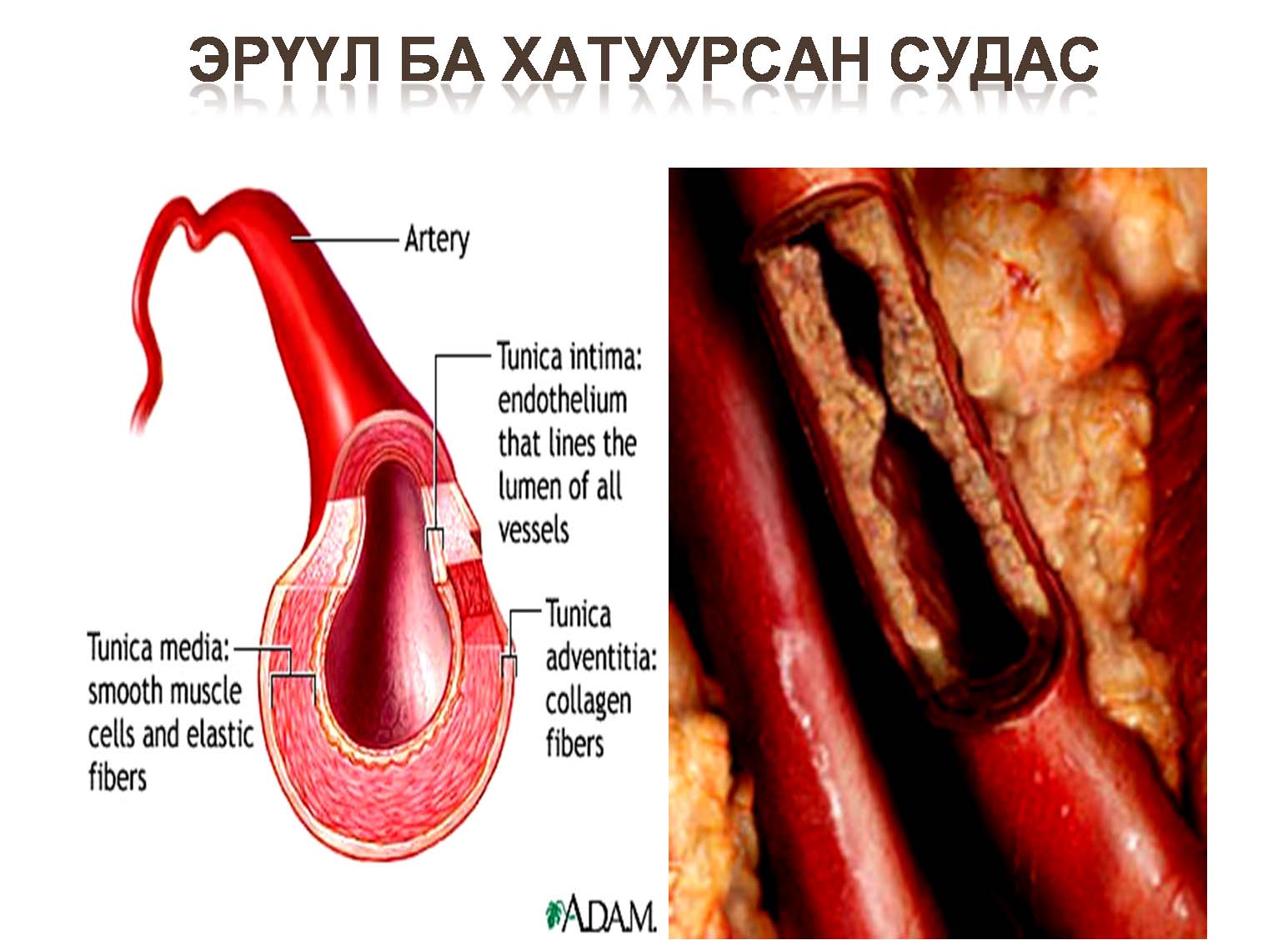 Судас хатуурах өвчин 